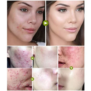 BIOAQUA Anti-Acne Treatment Face Cream Facial Serum Cleanser Mask Oil Control Shrink Pores Moisturizing Skin Whitening Care Set